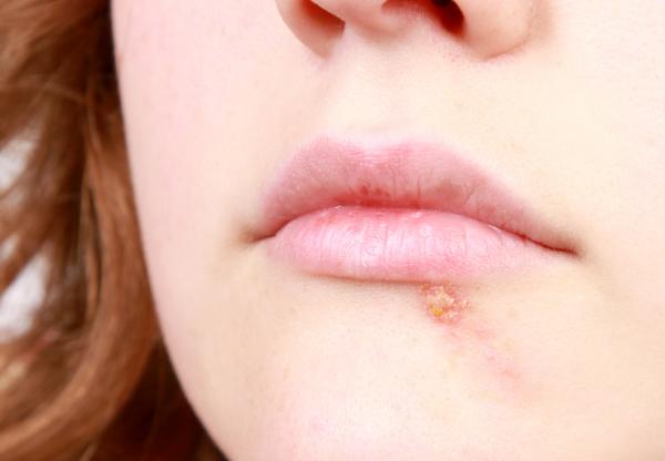 Ursachen von Fieber in den Lippen