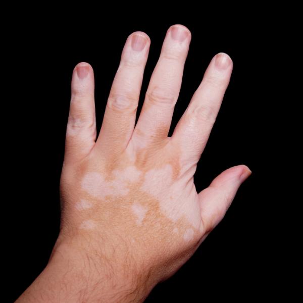 Ursachen für weiße Flecken auf der Haut