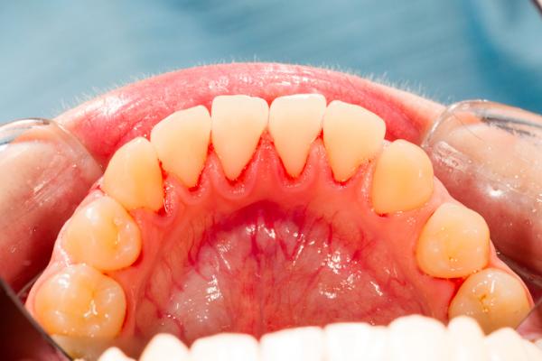 Wie man Zahnstein von meinen Zähnen säubert