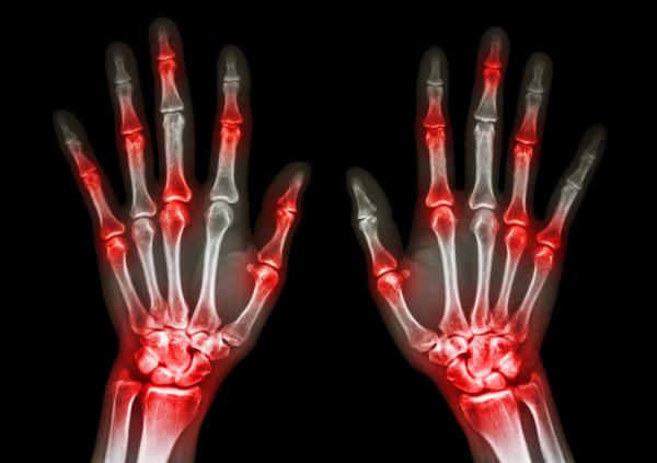 Wie behandelt man rheumatoide Arthritis mit Kräutern?