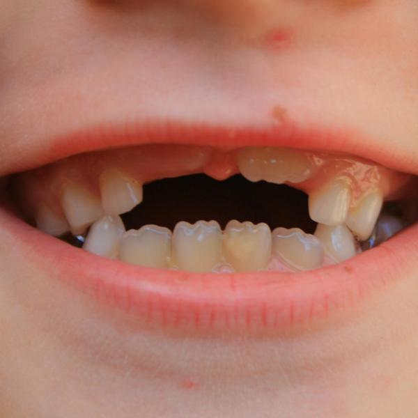 Was tun, wenn ein Zahn durch einen Schlag herausfällt?