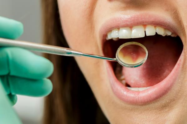 Heilmittel, um Zahnfleisch zu heilen