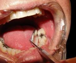 Wie man Plaque entfernt und Parodontitis vorbeugt