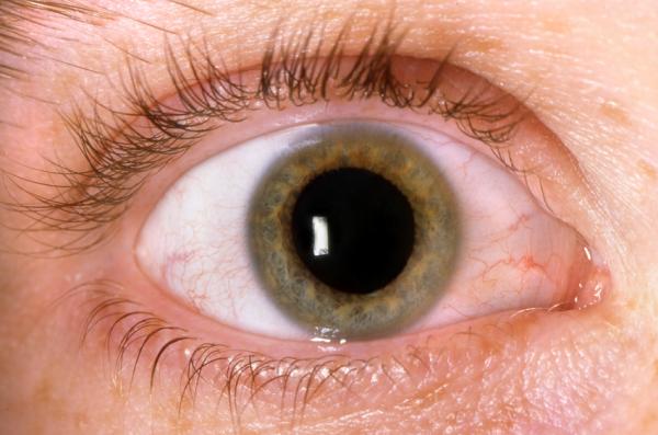 Wie man die Augen mit Bindehautentzündung säubert