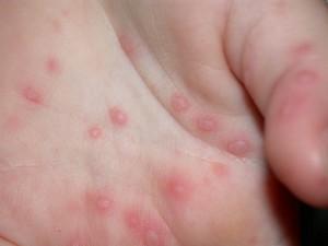 Wie verbreitet das Virus Hände, Füße und Mund?