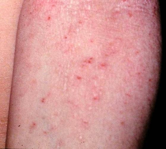 Wie man atopische Dermatitis behandelt