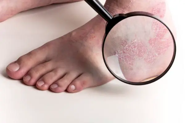 Wie man Psoriasis an den Füßen behandelt