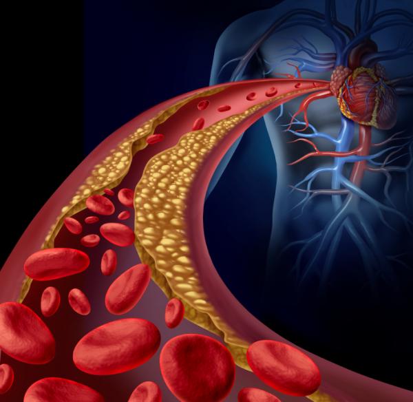 Was sind die Ursachen der Arteriosklerose?