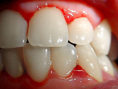 Warum blutet das Zahnfleisch?