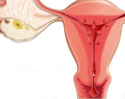 Wie sich die Retroversion des schwangeren Uterus manifestiert