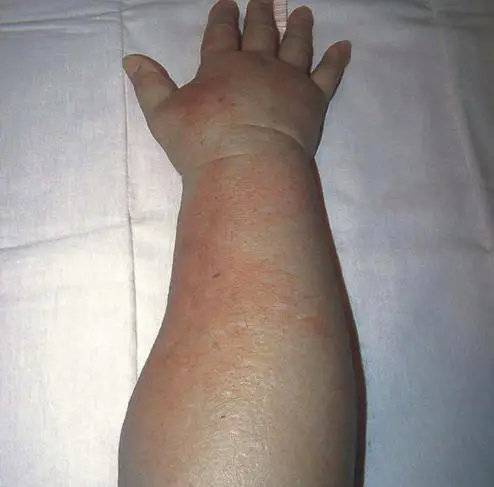 Wie behandelt man Lymphödeme im Arm?