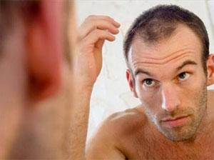Wie man Alopezie behandelt