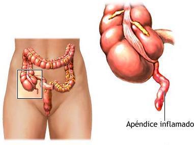 Wie man Appendizitis behandelt