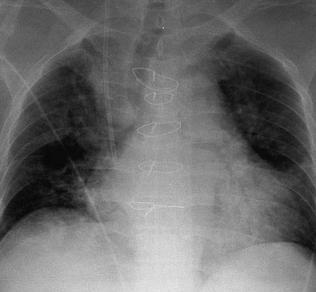 Wie man Lungenstauung behandelt