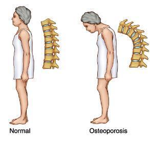 Wie man Osteoporose behandelt