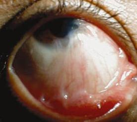 Wie man chemische Verbrennungen der Augen behandelt
