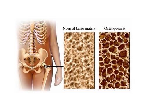 Was sind die Risikofaktoren für Osteoporose?