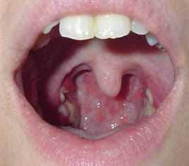 Wie chronische Tonsillitis zu heilen