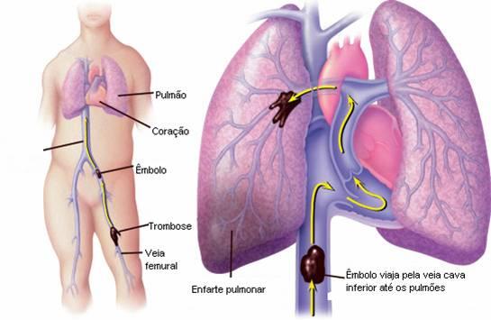 Wie zur Behandlung von Lungenembolie - Akute Phase
