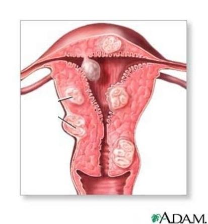 Was sind die Symptome eines Uterusmyomids?
