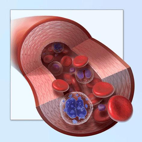 Risikofaktoren für tiefe Venenthrombose