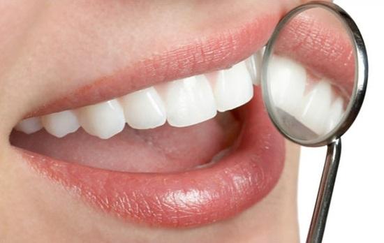 Wie man Zahnstein auf Zähnen vermeidet