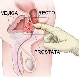 Wie man eine Selbstuntersuchung der Prostata macht