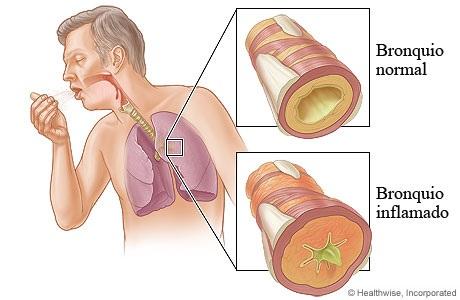 Wie man Bronchitis verhindert