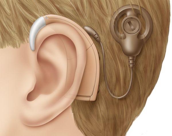 Was sind die Vorteile von Cochlea-Implantaten?