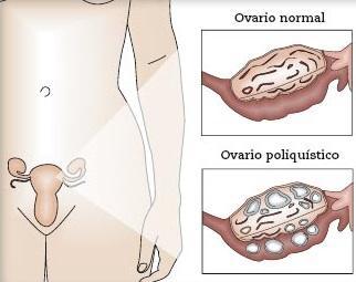 Was sind die Symptome von polyzystischen Ovarien?