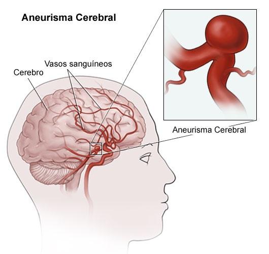 Was sind die Ursachen des zerebralen Aneurysmas?