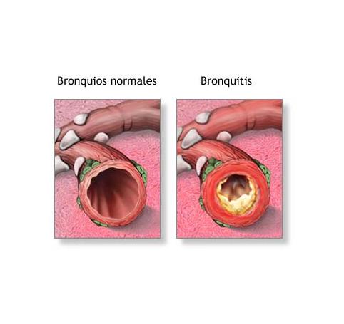 Was sind die Symptome einer Bronchitis?