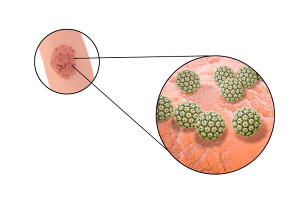 Was sind die Symptome von Humanem Papillomavirus, HPV Genital?
