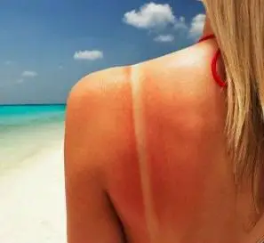 Wie man Sonnenbrand auf der Haut behandelt