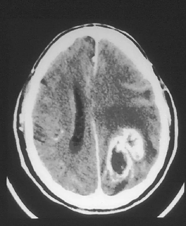 Was sind die Symptome eines Hirntumors?