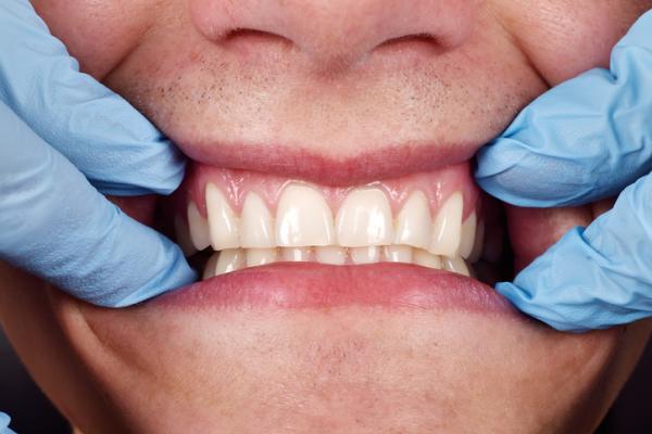 Wie man entzündetes Zahnfleisch heilt - hier die Antwort