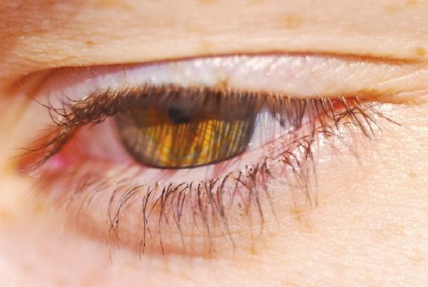 Wie behandelt man ein Ekzem an den Augenlidern