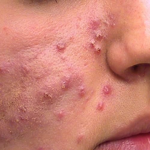 Was sind die Symptome von Erwachsenen Akne