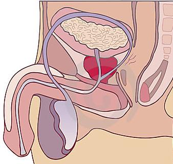 Prostatitis - Ursachen, Symptome und Behandlung