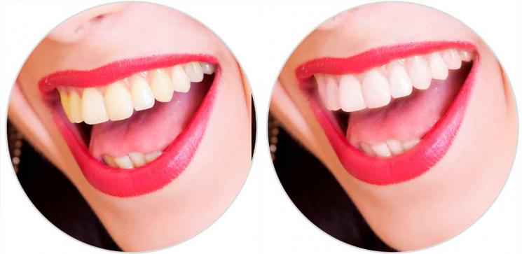 7-whitening-teeth-photoshop.jpg